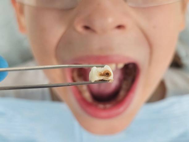 Best Emergency Dentist for Lost Fillings or Crowns in Wolf Lake, MI